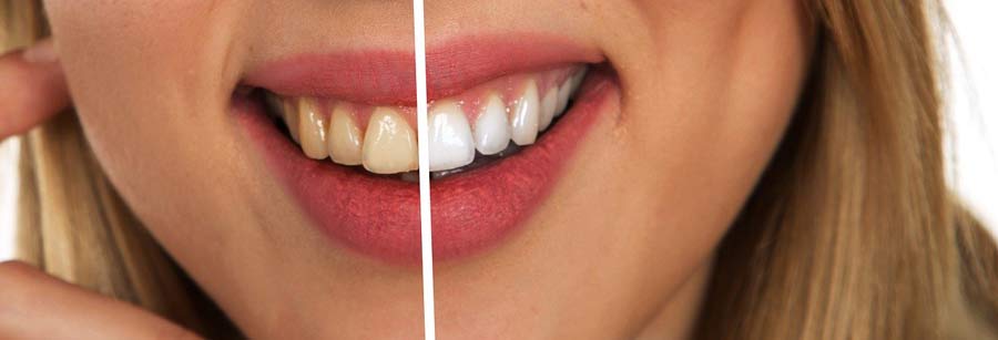 Teeth-Whitening-West-Auckland